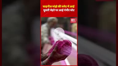 चाइनीज मांझे की चपेट में आई युवतीचेहरे पर आई गंभीर चोट #kite #chhattisgarh #shorts