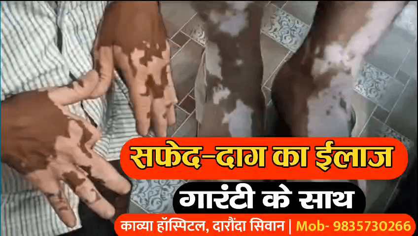 गोड्डा: सिवान जिले के काव्या सेवा सदन में सफेद दाग का गारंटी के साथ हो रहा है ईलाज, दवा का असर नहीं तो पैसा वापस | 9835730266