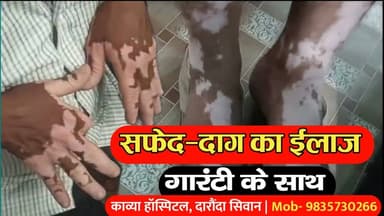 सिवान जिले के काव्या सेवा सदन में सफेद दाग का गारंटी के साथ हो रहा है ईलाज, दवा का असर नहीं तो पैसा वापस | 9835730266